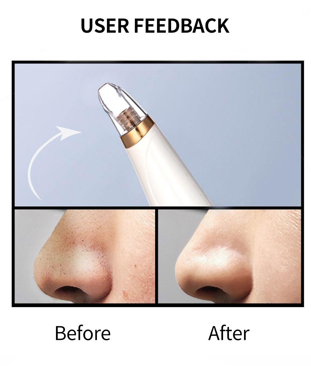 Blackhead Remover Deep Pore Cleaner  Facial SPA - foxberryparkproducts